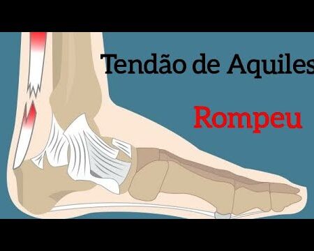 Coman en Riesgo para el Partido contra la Roma por Inflamación en el Tendón de Aquiles
