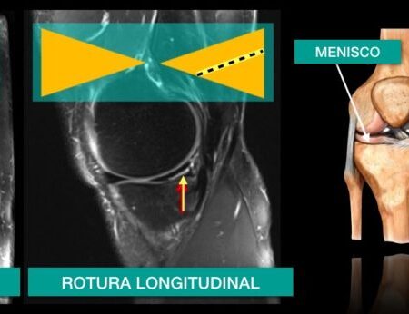 Bremer, otra vez lesionado: rotura de menisco y baja hasta después del parón de noviembre